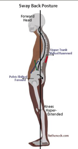 The Sway Back Posture