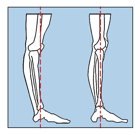 Hyperextension of the knees